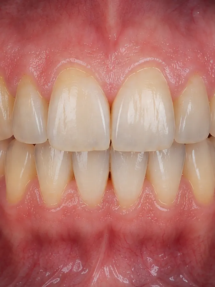 Sorriso antes do clareamento dental