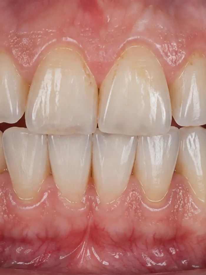 Sorriso antes das lentes de contato dental