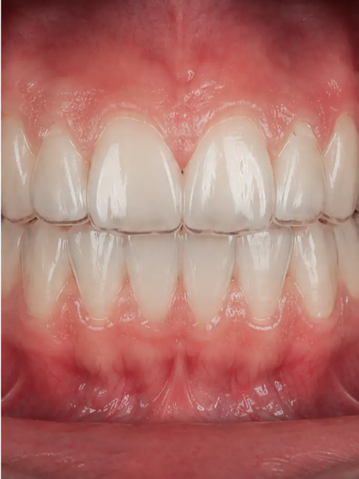 Sorriso alinhado depois do alinhador invisível