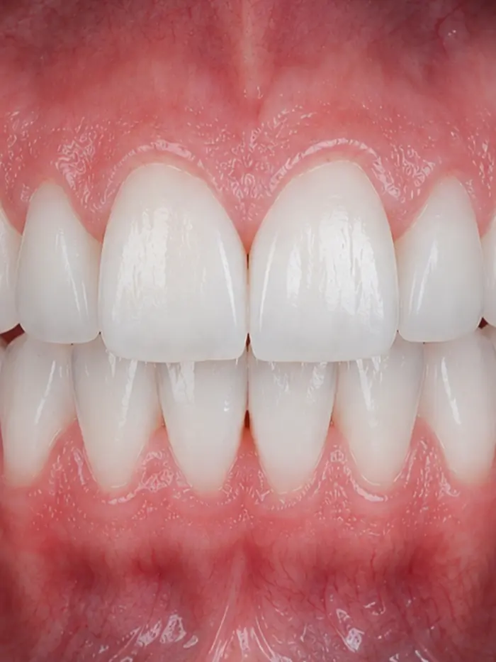 Sorriso depois do clareamento dental