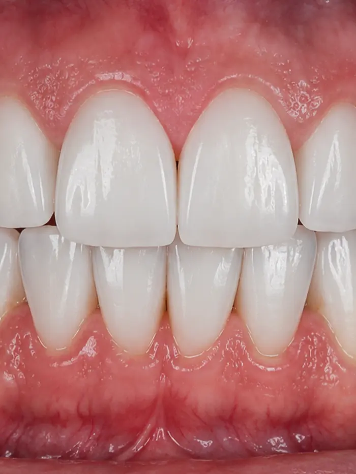 Sorriso depois das lentes de contato dental
